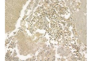 ABIN6261019 and ABIN6273216 at 1/100 staining human prostate carcinoma by IHC-P.