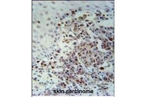 XRCC1 Antibody (Center) (ABIN651735 and ABIN2840381) immunohistochemistry analysis in formalin fixed and paraffin embedded human skin carcinoma followed by peroxidase conjugation of the secondary antibody and DAB staining. (XRCC1 antibody  (AA 407-435))