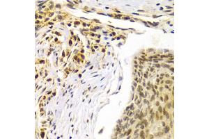 Immunohistochemistry of paraffin-embedded human esophageal cancer using SMARCE1 Antibody (ABIN5973097) at dilution of 1/100 (40x lens). (SMARCE1 antibody)