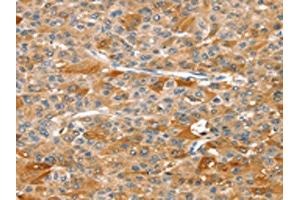 The image on the left is immunohistochemistry of paraffin-embedded Human liver cancer tissue using ABIN7129263(DSTYK Antibody) at dilution 1/25, on the right is treated with fusion protein. (DSTYK antibody)
