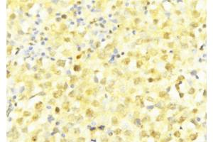 ABIN6277600 at 1/100 staining Human breast cancer tissue by IHC-P. (LITAF antibody  (Internal Region))