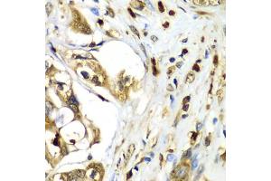 Immunohistochemistry of paraffin-embedded human liver cancer using TMOD4 antibody (ABIN5974100) at dilution of 1/100 (40x lens).
