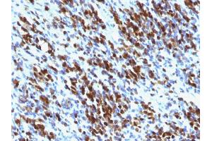 Formalin-fixed, paraffin-embedded human Rhabdomyosarcoma stained with Myogenin Mouse Monoclonal Antibody (MGN185+F5D) (Myogenin antibody  (AA 30-224))