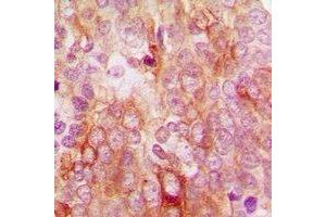 Immunohistochemical analysis of MCT12 staining in human breast cancer formalin fixed paraffin embedded tissue section. (SLC16A12 antibody)