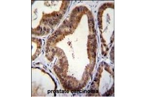 SHQ1 Antibody (N-term) (ABIN655661 and ABIN2845133) immunohistochemistry analysis in formalin fixed and paraffin embedded human prostate carcinoma followed by peroxidase conjugation of the secondary antibody and DAB staining. (SHQ1 antibody  (N-Term))