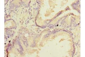 Immunohistochemistry of paraffin-embedded human prostate cancer using ABIN7172922 at dilution of 1:100 (SSR3 antibody  (AA 77-135))
