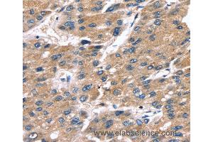 Immunohistochemistry of Human liver cancer using SRGN Polyclonal Antibody at dilution of 1:25 (SRGN antibody)