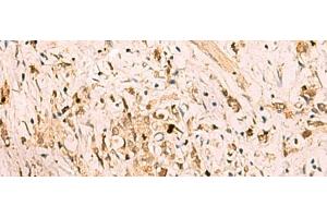 Immunohistochemistry of paraffin-embedded Human gastric cancer tissue using SGTA Polyclonal Antibody at dilution of 1:75(x200) (SGTA antibody)
