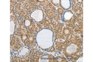 Immunohistochemistry of Human thyroid cancer using AKAP6 Polyclonal Antibody at dilution of 1:30 (AKAP6 antibody)