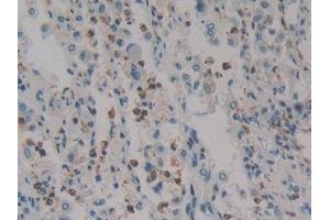 DAB staining on IHC-P; Samples: Human Lung cancer Tissue (HMGXB4 antibody  (AA 264-540))