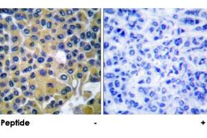 Immunohistochemical analysis of paraffin-embedded human breast carcinoma using IRS1 polyclonal antibody . (IRS1 antibody)