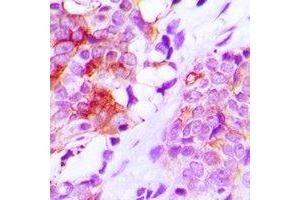 Immunohistochemical analysis of MRP1 staining in human lung cancer formalin fixed paraffin embedded tissue section. (MRP1 antibody)