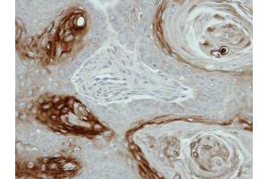 IHC-P Image Immunohistochemical analysis of paraffin-embedded Cal27 xenograft, using KLK7, antibody at 1:100 dilution. (Kallikrein 7 antibody)