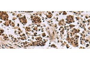 Immunohistochemistry of paraffin-embedded Human breast cancer tissue using SIK3 Polyclonal Antibody at dilution of 1:60(x200) (SIK3 antibody)