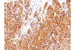 IHC testing of human melanoma stained with MART-1 antibody (M2-7C10). (MLANA antibody)