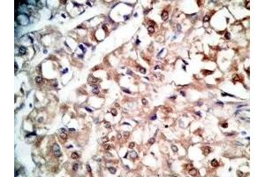 Human kidney cancer tissue was stained by rabbit Anti-BNP-45 (Mouse) Antiserum (BNP-45 antibody  (AA 51-95))