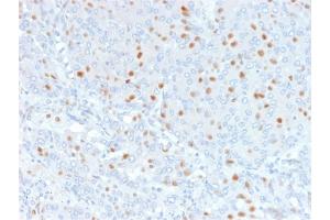 Formalin-fixed, paraffin-embedded human Bladder Carcinoma stained with Annexin A1 Mouse Monoclonal Antibody (6E4/3). (Annexin a1 antibody)
