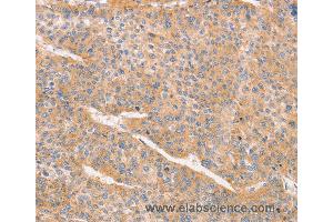 Immunohistochemistry of Human liver cancer using CD2AP Polyclonal Antibody at dilution of 1:70 (CD2AP antibody)