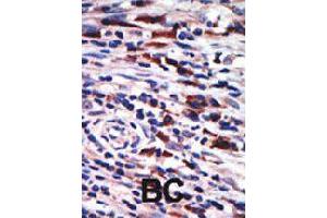 Formalin-fixed and paraffin-embedded human cancer tissue reacted with PRKCH polyclonal antibody  , which was peroxidase-conjugated to the secondary antibody, followed by AEC staining .