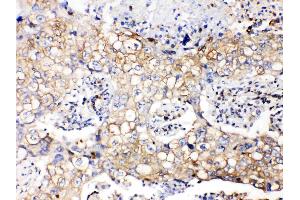 GAPDH was detected in paraffin-embedded sections of human lung cancer tissues using rabbit anti- GAPDH Antigen Affinity purified polyclonal antibody (Catalog # ) at 1 µg/mL. (GAPDH antibody  (AA 136-335))