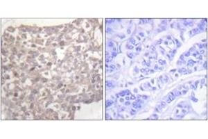 Immunohistochemistry analysis of paraffin-embedded human breast carcinoma tissue, using Tubulin gamma Antibody. (TUBG1 antibody  (AA 386-435))