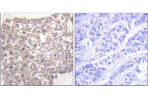 Immunohistochemistry analysis of paraffin-embedded human breast carcinoma tissue, using Tubulin gamma Antibody.