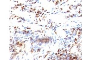 Formalin-fixed, paraffin-embedded human colon carcinoma stained with p27Kip1 antibody (KIP1/769) (CDKN1B antibody)