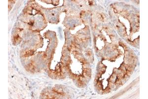 Formalin-fixed, paraffin-embedded human Prostate Carcinoma stained with FOLH1 Mouse Monoclonal Antibody (FOLH1/2354). (PSMA antibody  (AA 232-433))