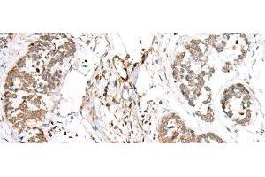 Immunohistochemistry of paraffin-embedded Human esophagus cancer tissue using BAG2 Polyclonal Antibody at dilution of 1:40(x200) (BAG2 antibody)