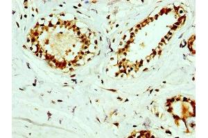 IHC image of ABIN7167302 diluted at 1:400 and staining in paraffin-embedded human breast cancer performed on a Leica BondTM system. (RAB35 antibody  (AA 1-201))