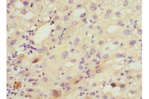 Immunohistochemistry of paraffin-embedded human liver cancer using ABIN7149242 at dilution of 1:100 (CYP2C18 antibody  (AA 231-490))