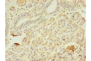 Immunohistochemistry of paraffin-embedded human breast cancer using ABIN7176718 at dilution of 1:100 (AZGP1 antibody  (AA 61-210))