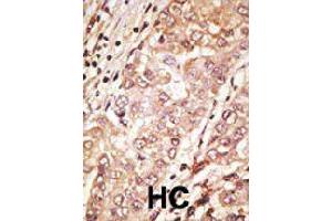 Formalin-fixed and paraffin-embedded human hepatocellular carcinoma tissue reacted with TDGF1 polyclonal antibody  , which was peroxidase-conjugated to the secondary antibody, followed by AEC staining.