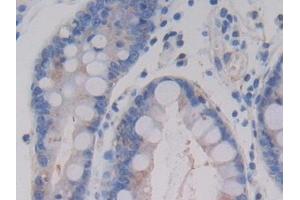 Detection of AMH in Human Stomach cancer Tissue using Monoclonal Antibody to Anti-Mullerian Hormone (AMH) (AMH antibody)