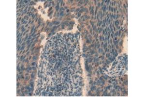 Detection of TIGIT in Human Esophagus Cancer Tissue using Polyclonal Antibody to T-Cell Immunoreceptor With Ig And ITIM Domains Protein (TIGIT)