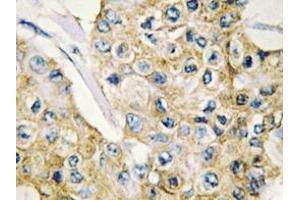 Immunohistochemistry analyzes of DAPP1 antibody in paraffin-embedded human breast carcinoma tissue.