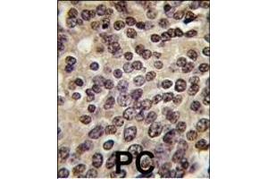 Formalin-fixed and paraffin-embedded human prostata carcinoma tissue reacted with PKN beta antibody (C-term), which was peroxidase-conjugated to the secondary antibody, followed by DAB staining. (PKN beta antibody  (C-Term))