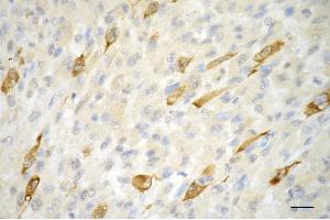 Immunohistochemistry was performed on paraffin-embedded human melanoma using phospho-CDK2 (Thr14) antibody (ABIN7798210), 1:200). (Recombinant CDK2 antibody  (pThr14))