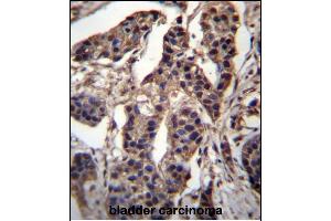 CABIN486182 and ABIN1535563 Antibody (N-term) (ABIN657088 and ABIN2837891) immunohistochemistry analysis in formalin fixed and paraffin embedded human bladder carcinoma followed by peroxidase conjugation of the secondary antibody and DAB staining. (C7ORF25 antibody  (N-Term))
