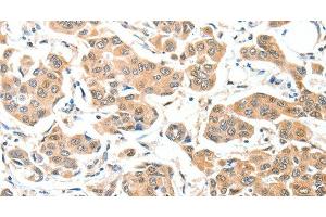 Immunohistochemistry of paraffin-embedded Human breast cancer tissue using ADCK1 Polyclonal Antibody at dilution 1:40 (ADCK1 antibody)