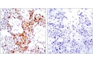 Immunohistochemistry analysis of paraffin-embedded human breast carcinoma, using ATF2 (Phospho-Thr69 or 51) Antibody. (ATF2 antibody  (pSer69))