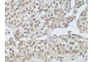 Immunohistochemistry of paraffin-embedded human breast cancer using ESR1 antibody.