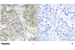 Immunohistochemistry analysis of paraffin-embedded human breast carcinoma tissue, using ANO9 polyclonal antibody . (ANO9 antibody)