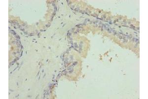 Immunohistochemistry of paraffin-embedded human prostate cancer using ABIN7156409 at dilution of 1:100
