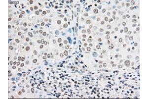 Immunohistochemical staining of paraffin-embedded Adenocarcinoma of colon tissue using anti-BRAFmouse monoclonal antibody.