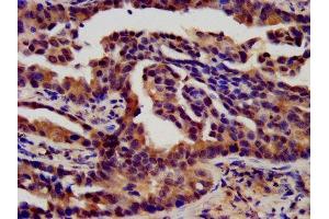 IHC image of ABIN7152837 diluted at 1:450 and staining in paraffin-embedded human lung cancer performed on a Leica BondTM system. (FGFR3 antibody  (AA 23-375))
