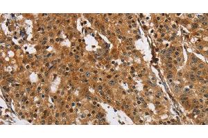 Immunohistochemistry of paraffin-embedded Human gasrtic cancer tissue using PTK6 Polyclonal Antibody at dilution 1:40 (PTK6 antibody)