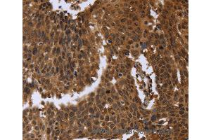 Immunohistochemistry of Human cervical cancer using FGFRL1 Polyclonal Antibody at dilution of 1:40 (FGFRL1 antibody)