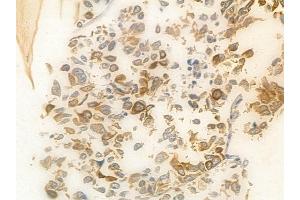 ABIN6265557 and ABIN6278407 at 1/100 staining human lung squamous cell carcinoma by IHC-P. (THOC1 antibody  (C-Term))