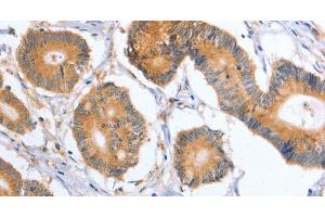 Immunohistochemistry of paraffin-embedded Human colon cancer tissue using BLNK Polyclonal Antibody at dilution 1:50 (B-Cell Linker antibody)